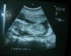 ultrasound-19weeks